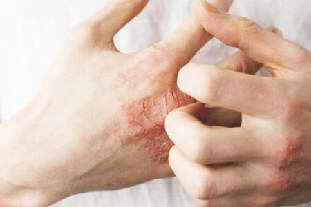 چگونه می‌توان از آسیب‌های پوستی پیشگیری کرد؟